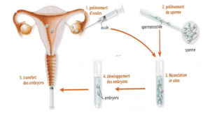 L’histoire de la Fécondation In Vitro