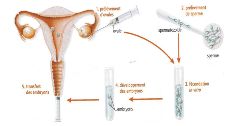 La fécondation in vitro, début et histoire