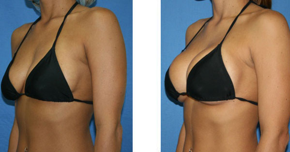 augmentation seins esth&eacute;tique