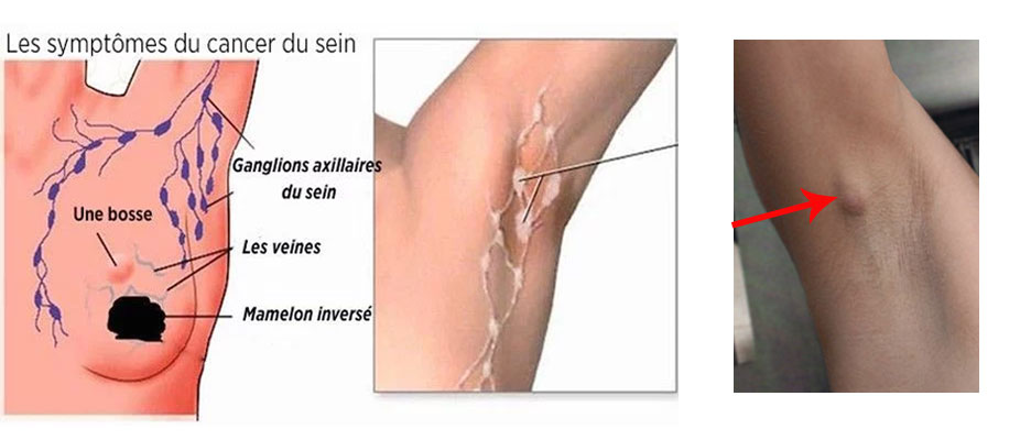 Illustration des principaux symptômes du cancer du sein : masse, changement de forme, peau d’orange, rétraction du mamelon et ganglions enflés