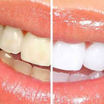 Le vinaigre blanc : efficace pour détartrer les dents