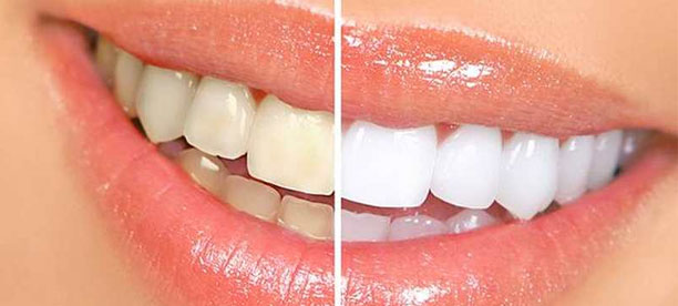 Le vinaigre blanc : efficace pour détartrer les dents