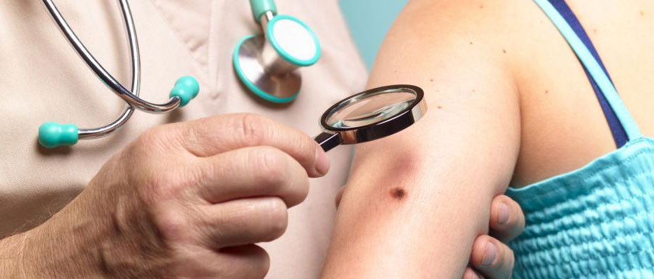Règle ABCDE des grains de beauté : identifier les signes d’alerte du cancer de la peau
