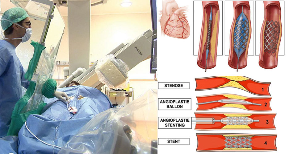 Angioplastie : le traitement des pathologies artérielles à l'aide d'un stent