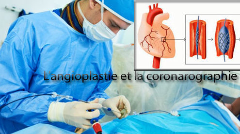 L’angioplastie et la coronarographie, indispensables pour prévenir les risques cardiaques