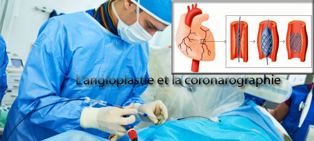 L’angioplastie et la coronarographie, indispensables pour prévenir les risques cardiaques