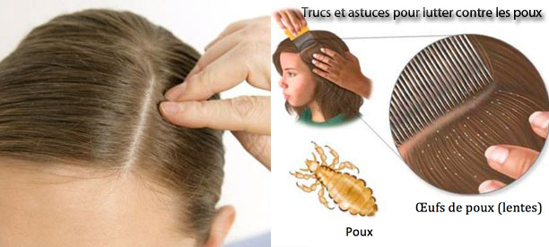 Trucs et astuces pour lutter contre les poux
